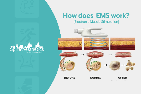 EMS treatment for post pregnancy weight loss treatment Coombe