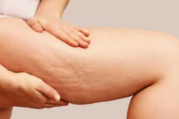 Image of woman showing leg with cellulite Coombe