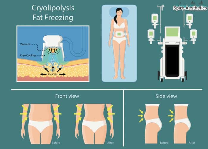 Image of diet and fat freezing combined for best results for Spire Aesthetics Coombe