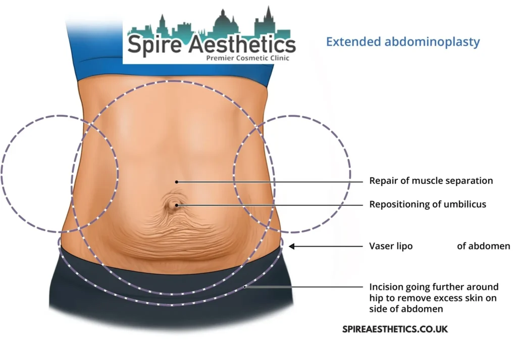 Understanding Loose Skin After Gastric Band Coombe Surgery and HIFU Treatment