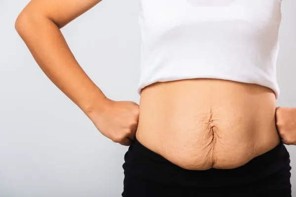 Image of a woman's stomach after weight loss with sagging skin following a gastric band Coombe
