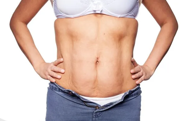 sagging skin on woman's stomach after weight loss injections Coombe