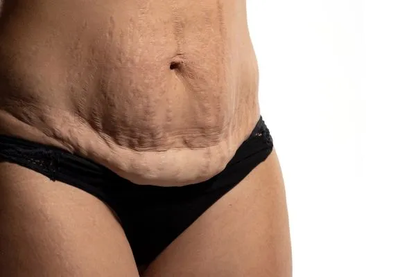 Image of womans stomach after weight loss injections Coombe showing saggy skin